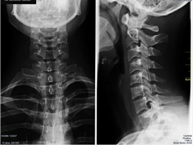 cervicale-ap-ll_sito